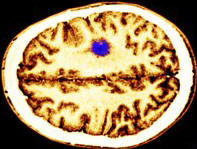 Brain tumour
